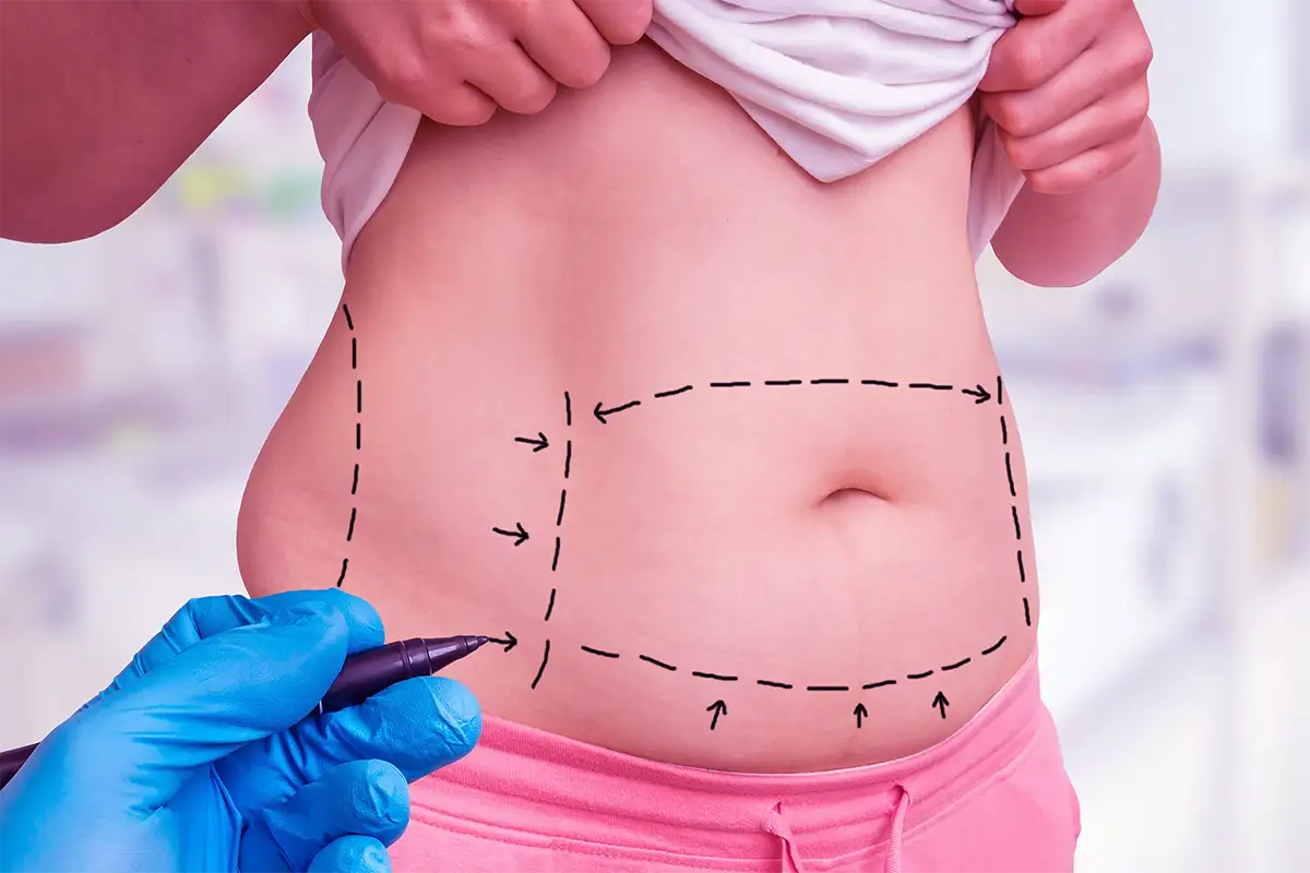 preparing for liposuction